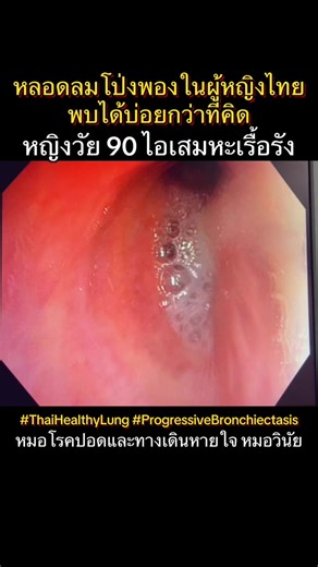 หลอดลมโป่งพองในผู้หญิงไทย…พบได้บ่อยกว่าที่คิด ภาพจากการส่องกล้องหลอดลมของผู้ป่วยหญิงอายุ 90 ปีมาด้วย หลอดลมโป่งพอง (bronchiectasis) ที่ดำเนินโรคมากขึ้นเรื่อย ๆโดยไม่สามารถระบุสาเหตุจากการตรวจเสมหะได้ชัดเจน จากการส่องกล้องพบ มีเสมหะลักษณะ ข้น เหนียว หนืด สีเหลืองเขียว (thick, sticky, purulent mucoid impaction) อุดตันอยู่ภายในหลอดลมจำนวนมาก ในเวชปฏิบัติของผม ผู้ป่วยส่วนใหญ่เป็น ผู้หญิงสูงอายุมีอาการไอเรื้อรัง มีเสมหะหนองเรื้อรังมานานหลาสิบปีได้รับยาปฏิชีวนะซ้ำ ๆ หลายครั้ง ภาพถ่ายรังสีทรวงอกหรือ CT