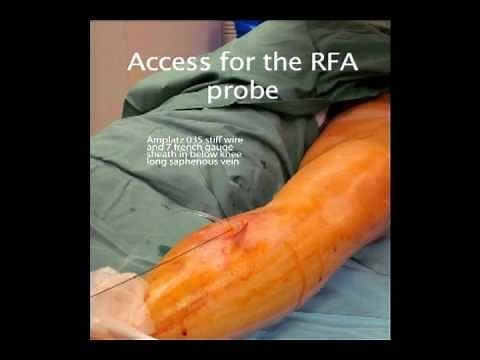 Thermal Ablation of Varicose Veins by Radio Frequency Ablation