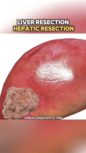 Liver Resection (Hepatic Resection) Surgery (3-D#Anatomy #KNP3DAnimation