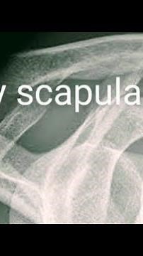 x-ray scapula ap / lateral view