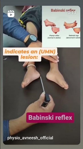 A positive Babinski sign indicates an upper motor neuron (UMN) lesion.