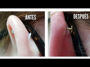 RECTIFICACIÓN/CORRECCIÓN PERFORACIÓN HÉLIX QUE DESPUÉS DE 2 AÑOS NO DABA CICATRIZADO!! 😉😉😉😉