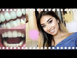 GETTING MY BRACES OFF! | VLOG