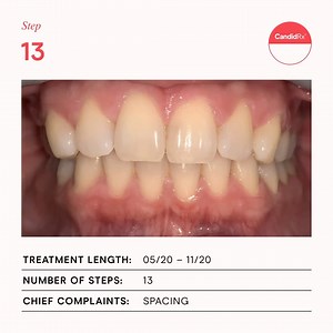 4.2K views · 12 reactions | In just 6.5 months, this Candid customer was able to close their gap and tackle their biggest insecurity – all from the comfort of home. | Candid | Facebook