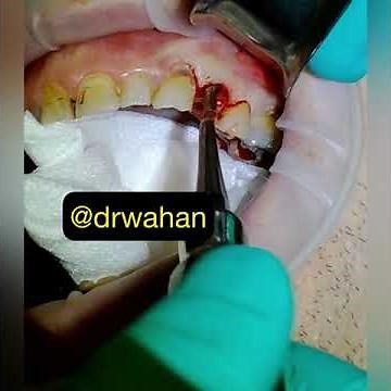 Root Extraction Video