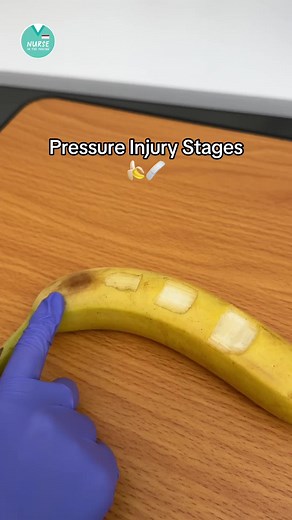 Understanding the Stages of Pressure Injuries