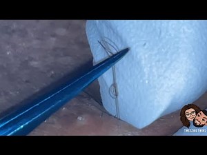 Ingrown Hair Removal Ep28