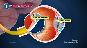 Glaucoma