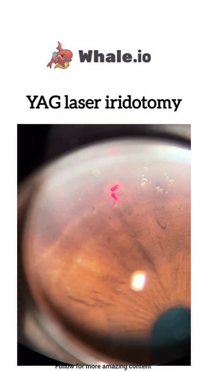 Ak Nursing Academy on Instagram: "A YAG Laser Iridotomy is a quick, outpatient eye procedure using a specialized laser (YAG) to create a tiny hole in the iris (colored part of the eye) to improve fluid drainage, primarily to treat or prevent angle-closure glaucoma by relieving pressure buildup, allowing fluid to flow from the back to the front of the eye, preventing sudden, damaging pressure spikes, and often done in both eyes. . . . Only for education purpose. Contact us for remove or credit. .