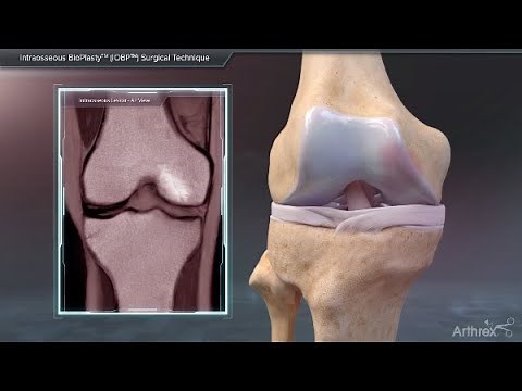 Intraosseous BioPlasty™ (IOBP) Surgical Technique