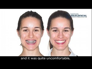 Jaw surgery Case # 96: Maria - Class III, maxillary hypoplasia, severe open bite