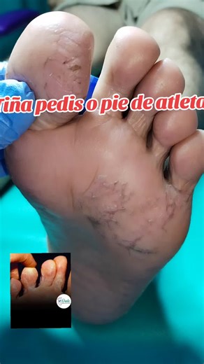 Tiña Pedis: Tratamiento Efectivo para Pie de Atleta