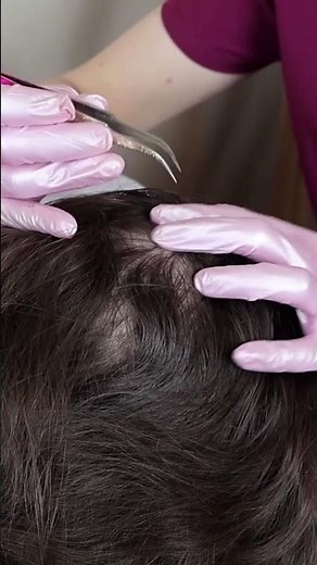 ASMR School Nurse LICE Check on Scalp and Nape | Lice Removal with Tweezers #short #asmr #shorts