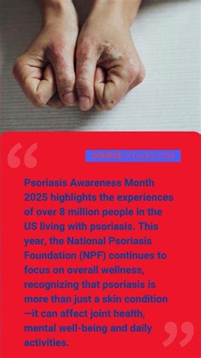 Psoriasis Awareness Month 2025: Advancing Research, Treatment and Understanding