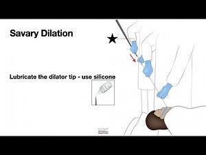 HCC 1475-38d-Bougie Dilator With Wire