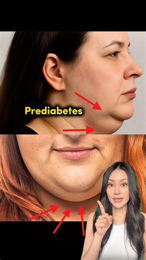 Tanda-tanda Prediabetes di Kulit Jangan disepelekan‼️ | dr. Clarin Hayes,M.Biomed (AAM)