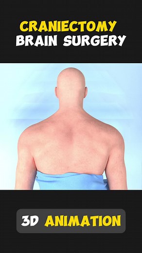 Craniectomy Brain Surgery 3D Animation #craniectomy #craniectomyprocedural #craniotomy #craniotomyrecovery #craniotomysurvivor #awakecraniotomy #brainsurgery #brainsurgerysurvivor #brainsurgerywarrior #craniotomysurgeon #medical3danimation #3dmedicalanimation #education #medical