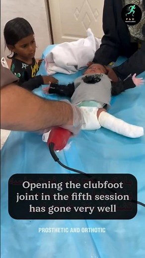 Serial casting removal 🦵 Step towards mobility & confidence! #Prosthetics #Orthotics #Rehab #Casting