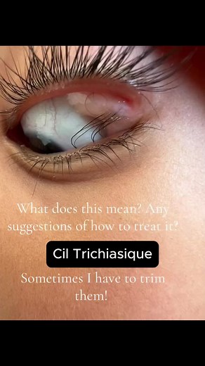Dystrichiasis lashes are lashes that grow in a new row, often alongside normal lashes, while trichiasis lashes grow in the wrong direction, towards the cornea, which can cause eye irritation. 👉Both conditions can lead to discomfort and risks to eye health, requiring appropriate medical management. #fyp #Health #Myopic #Medicine