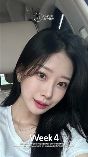 Facial Contouring Surgery Before After, Plastic Surgery in Korea #plasticsurgerykorea #vlinesurgery