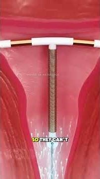 Ever Wondered How an IUD Works Inside the Uterus? IUD insertion #iud #iudinsertion #birthcontrol