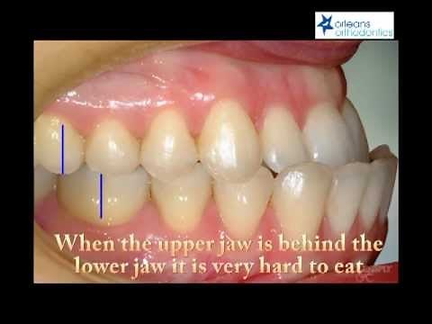 Correcting an Underbite at Orleans Orthodontics