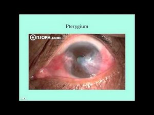 Other Conjunctival Disorders - CRASH! Medical Review Series