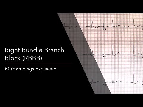 Right Bundle Branch Block (RBBB) ECG