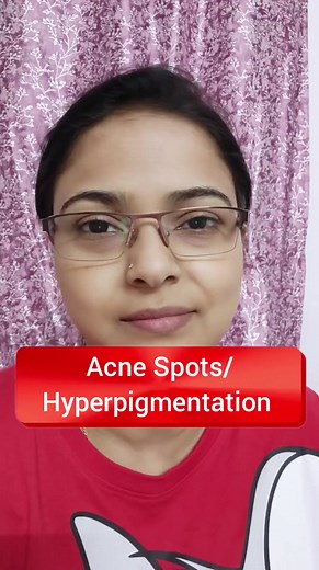 Acne scars & Hyperpigmentation 😢😢😢 #reels #facebook #viralreels #skin #hair #health #ojas #hho #drshaistakhan #ojasclinic Disclaimer: Using my video or my content without my permission is an offence. You cannot share it on your Instagram, YouTube channel, Twitter, Facebook or any other social media platforms. Any information on diseases and treatment available on this video are educational and informational purposes only and are not intended as a diagnosis, treatment or as a substitute for pr