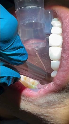 Stress-Free Fillings with the Solea Laser | Manyak Dental Group