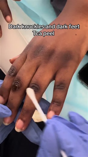 Dark Knuckles and Feet Treatment with TCA Peel