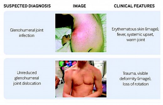 Assessment of shoulder pain for non-specialists