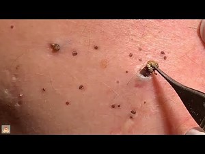 Oddly satisfying video pimple popping,pimple popping satisfying video whiteheads