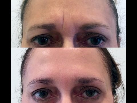 Forehead / Glabella "11" Rejuvenation with Botox and Restylane