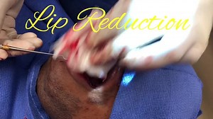 Dr. Parikh Reducing the Upper and Lower Lip (GRAPHIC)