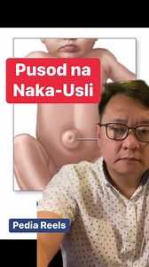 Pusod na naka usli. #umbilicalhernia #pusod #pediareels | Dr. Richard and Erika Mata