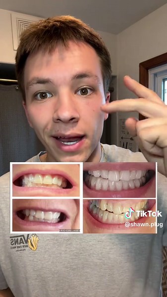 Transform Your Teeth Health with Lumineers Toothpaste