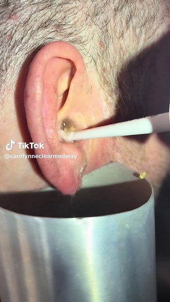Expert Earwax Removal Techniques by a Nurse