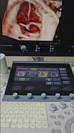 Fetal Echo | 4 Chamber View | 4D Ultrasound