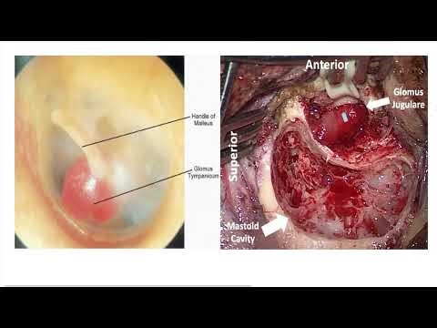 Ear History: Tinnitus & Otalgia