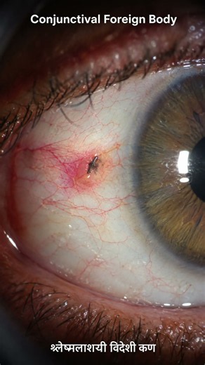 Slit lamp examination 👀🔬#eyecare #medical #optometry #surgery