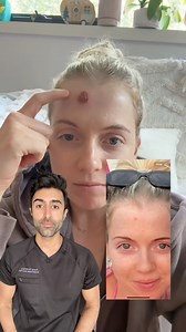 10K views · 85 reactions | ✨ Did you know the most common skin cancer, basal cell carcinoma (BCC), affects 3.6 million Americans each year? If you are outside for more than 15 minutes during peak sun exposure hours (10-4) consider wearing sunscreen, look for shaded areas, and cover your skin as much as you can.  Don’t let a small spot go unchecked—early detection is key! What’s your go-to way to stay sun-safe?  VC: @rachel.olivia_ | Kunal Sood, MD | Facebook