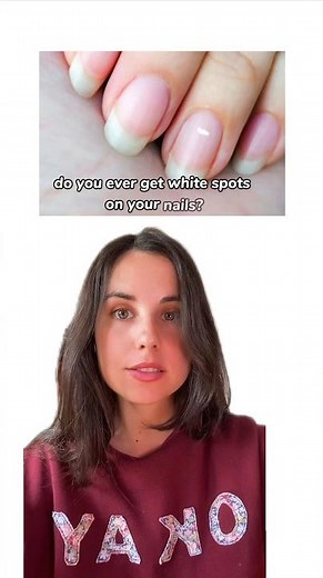 Causes of white spots on nails