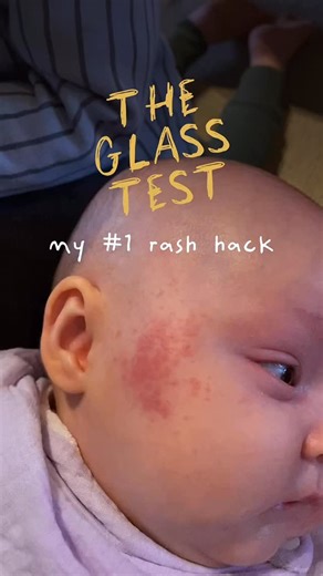Experts in Baby First Aid, Choking, Solids & Pregnancy | If you ever notice a sudden rash on your child, this simple check can help you work out if it’s something serious or not. When a rash... | Instagram