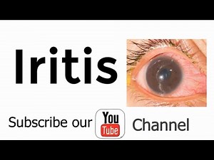 Iritis definition, risk factors and causes