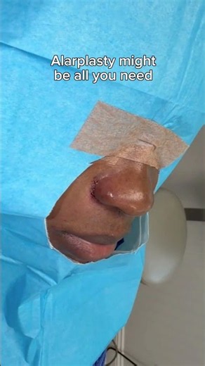 Alarplasty (Nostril Narrowing) Before and After 3 Month Post-Op Results - Dr. Tanveer Janjua
