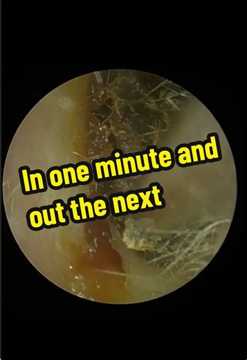 Effective Earwax Removal Techniques You Can Try