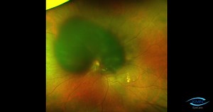 Subretinal tPA Injection - Eyetube