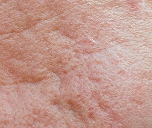 Rolling Scars - acne support