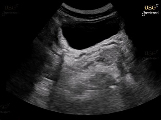 10K views · 191 reactions |  #ultrasoundscan #radiology #medical #pregnancy #sonologist #urine #sonography #ultrasoundtech #radiologist #stone #UretericStone | Ultrasound report expert | Facebook